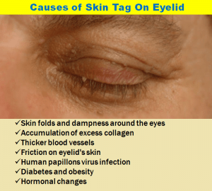 skin tag on eyelid home remedy