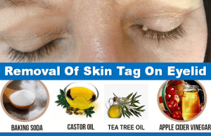removing skin tags on eyelids at home