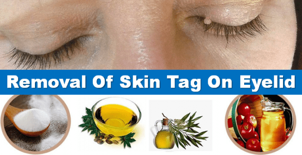 skin tag removal around eyes