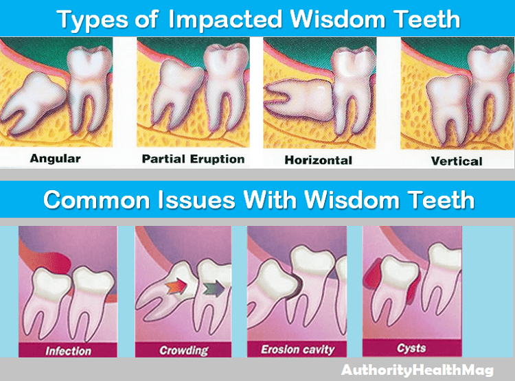 Cost Of Wisdom Teeth Extraction Surgery Tooth Impaction