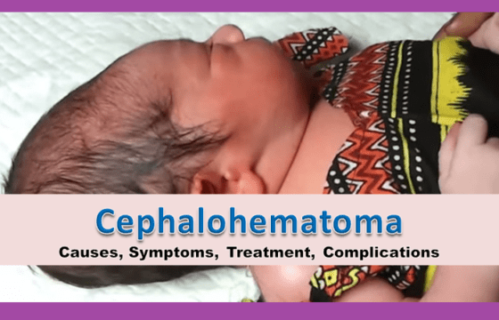 Cephalohematoma Causes Symptoms Treatment Complications